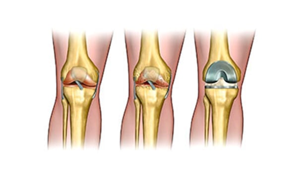Knee-Doctor-in-Orange-County-Orange-County-Orthopedic-Group-4