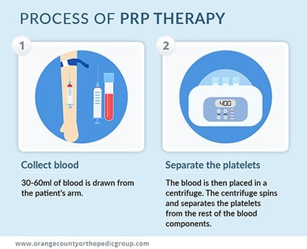Process-of-PRP-Therapy-OC-Orthopedic-Group