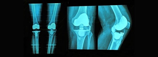 Traditional Knee Replacement vs. Minimally Invasive Knee Replacement