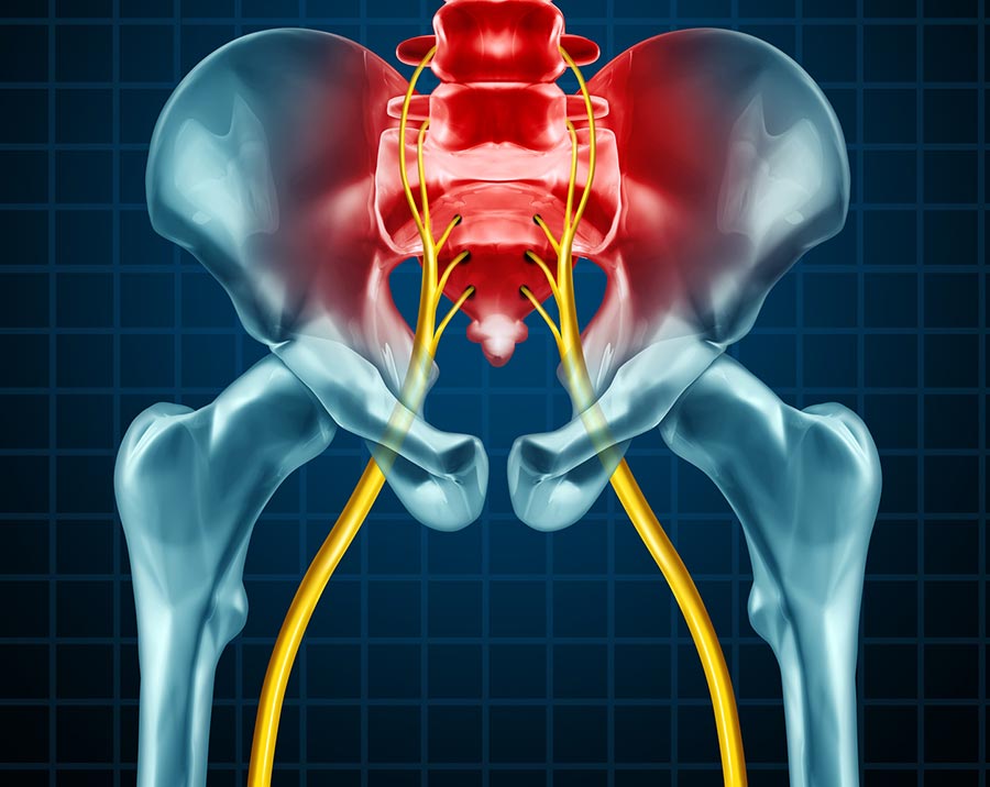 3D-illustration-of-sciatica-nerve-pain