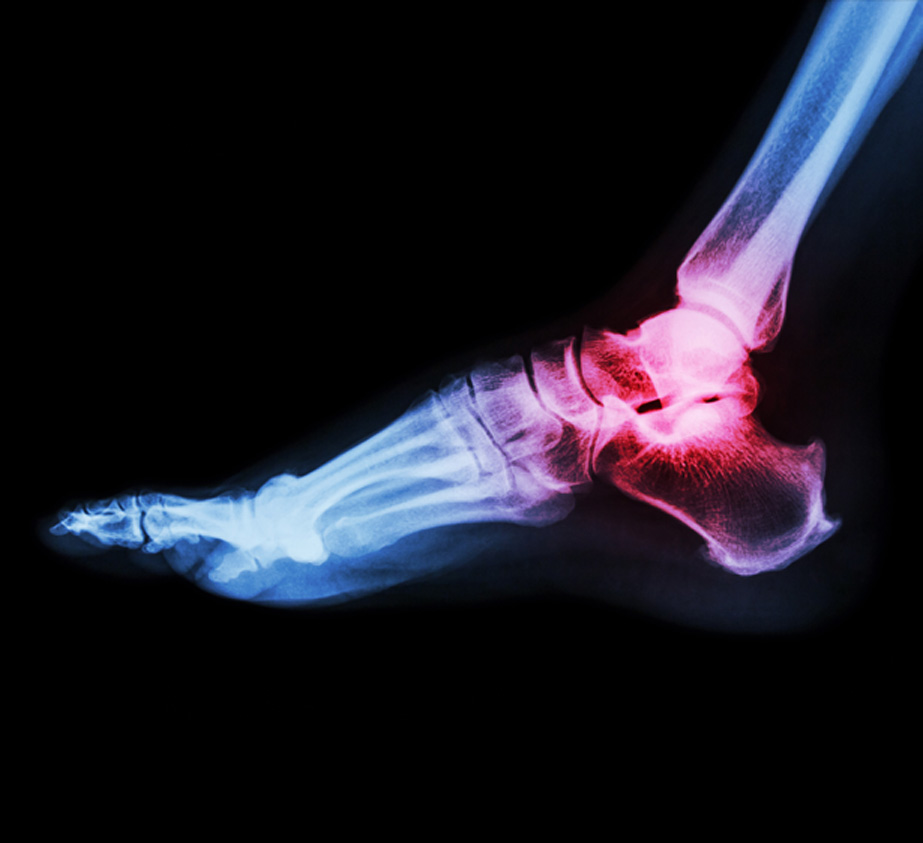 X-ray-of-ankle-pain-caused-by-arthritis