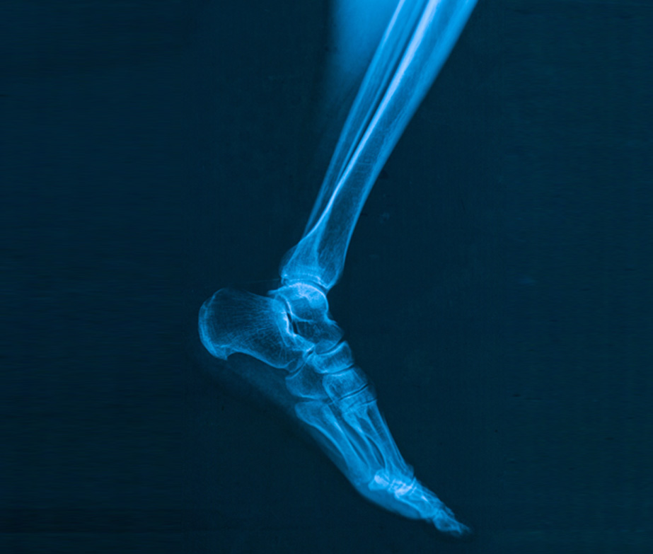 X-ray-of-ankle